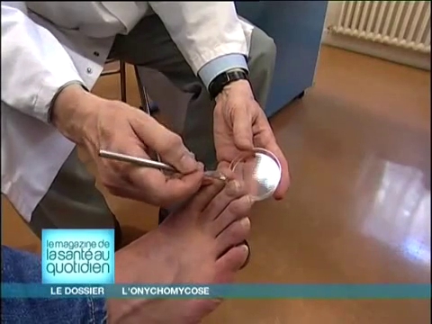 Comment se transmet le champignon responsable de l'onychomycose ?