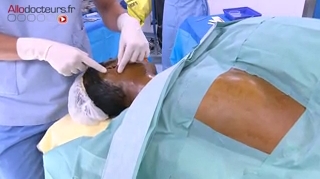 Attention, images d’intervention chirurgicale : le chirurgien sculpte le futur pavillon de l'oreille dans un morceau de cartilage.