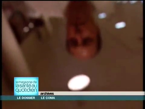 L'expression ''coma de stade IV'', encore couramment employée comme synonyme de ''mort cérébrale'', fait référence à une classification aujourd'hui largement tombée en désuétude.