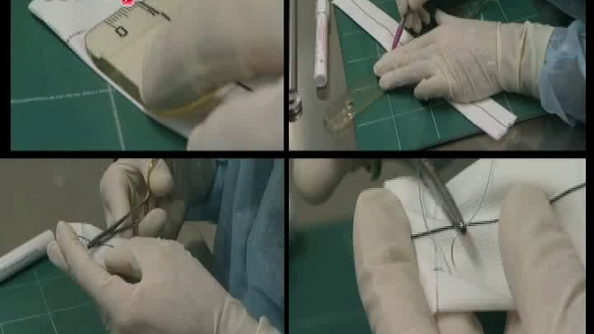 La fabrication d'une prothèse sur mesure pour renforcer la paroi d'une artère déformée par un anévrisme