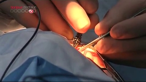 Attention, images d'intervention chirurgicale : l'opération ne nécessite pas de suture