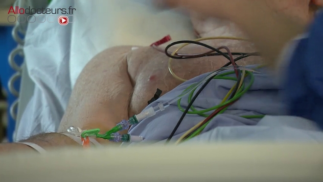 La pince à biopsie est introduite dans le catéther pour effectuer des prélèvements pulmonairess