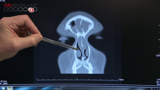 Attention, images de chirurgie ! L'intervention chirurgicale permet d'enlever les polypes qui se trouvent à l'intérieur du nez