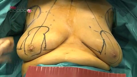 Attention, images de chirurgie. Objectif : remonter l'aréole et le mamelon.