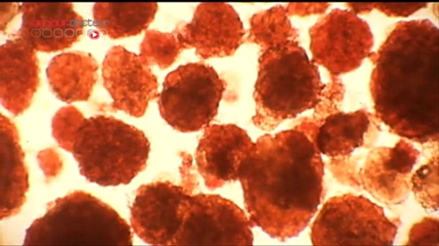 Diabète : l'espoir de la greffe de cellules pancréatiques
