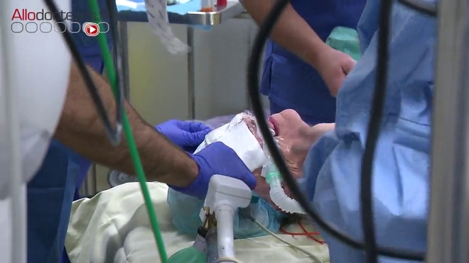Attention, images de chirurgie ! La partie qui bouche l'artère est progressivement retirée