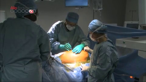 Attention, images de chirurgie : le chirurgien fait saigner la paroi interne de la plèvre pour créer une inflammation.
