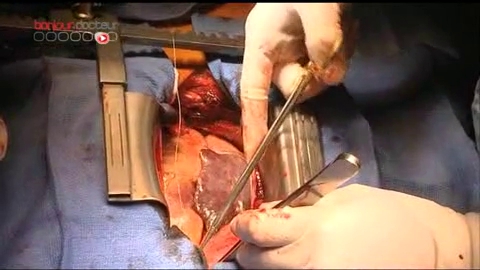 Attention, images de chirurgie : opération à cœur ouvert pour déboucher les artères