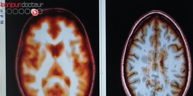 IRM du cerveau