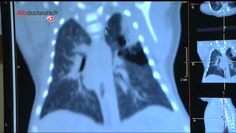 Attention images de chirurgie ! Le lobe malade est retiré à l'aide d'un sac déployé à l'intérieur de la cage thoracique.