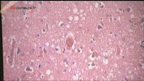 Reportage au Centre national de référence des prions et à l'Institut du cerveau et de la moelle épinière, où sont conduites des recherches sur le prion et la maladie de Creutzfeldt-Jakob.