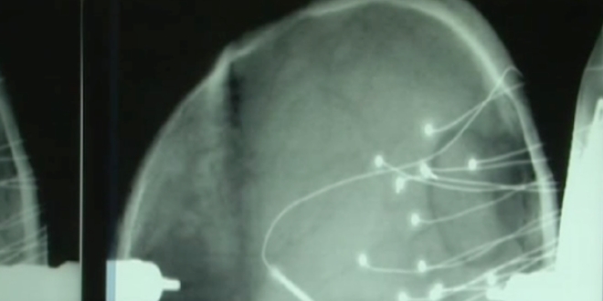 Electrodes insérées directement dans le cerveau des malades épileptiques