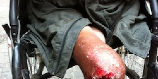 La jambe gangrenée d'un homme dans les rues de Metz