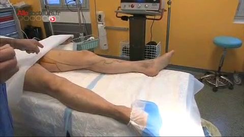 Attention, images de chirurgie ! L'intervention consiste à brûler la veine de l'intérieur en la laissant en place avec une fibre laser.