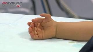 Attention images de chirurgie ! Reconstruction d'un pouce sur un bébé de 11 mois.