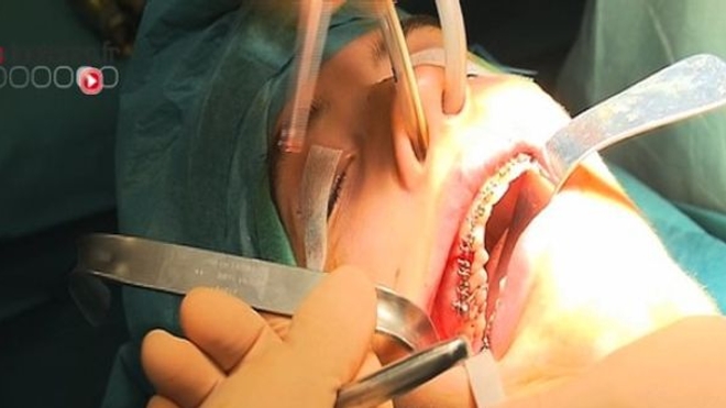 Malformations des mâchoires : une chirurgie lourde mais réparatrice