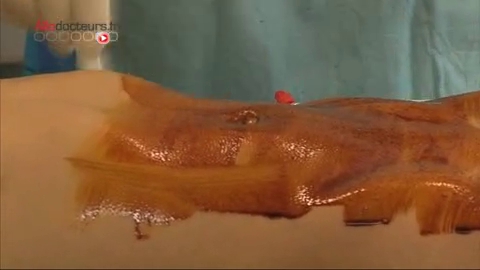 Attention images de chirurgie ! Retrait d'un kyste digestif sous coelioscopie