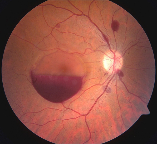 Le fond d'oeil du patient, présentant une large hémorragie prémaculaire et des hémorragies intrarétiniennes dispersées. (crédits : Kevin Harrison / BMJ Case Reports)