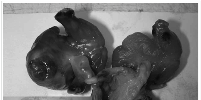 Foetus in foetu observés (Source : Hong Kong Medical Journal, février 2015)