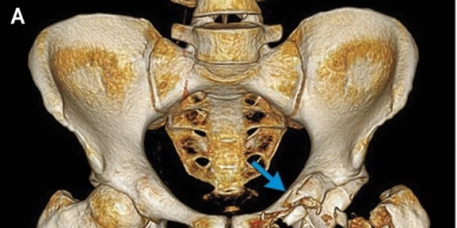 Tomographie axiale calculée par ordinateur (CT-scan) du bassin du patient. La flèche jaune pointe la tête du fémur, les flèches bleue et blanche, les zones de la hanche et du fémur fracturées lors de l'accident.