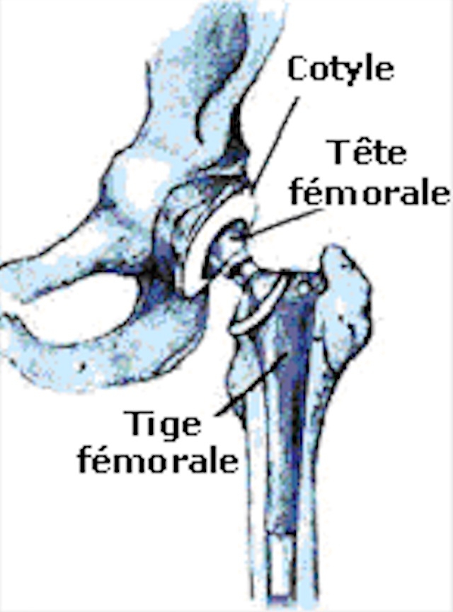 Schéma d'une prothèse totale de hanche. (ANSM)