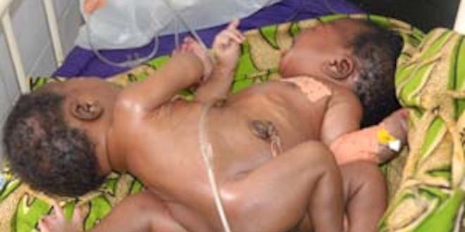 Les deux enfants, peu après leur naissance (DR). Selon le Dr Agbo-Panzo, chirurgien pédiatrique du CHU de Conakry interrogé par Le Figaro, Hassan et Boubacar étaient les premiers siamois à survivre à un accouchement en Guinée. 