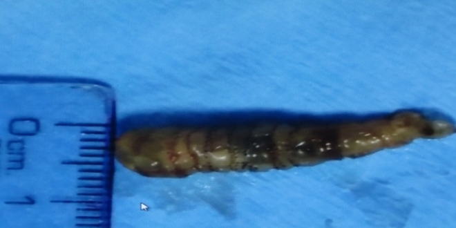 La larve extraite du visage de l'adolescent (source : ministère de la Santé du Pérou)
