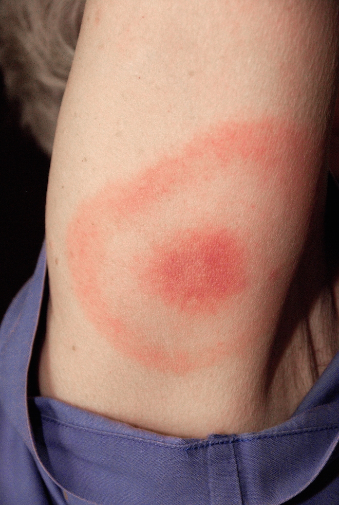 Typique de la maladie de Lyme, l'érythème migrant est une tâche rouge formant des anneaux.