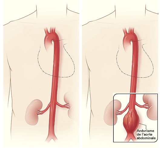 À gauche, artères saines quittant le coeur. À droite, anévrisme au niveau de l'artère abdominale. (crédits : Allodocteurs.fr, d'après NIH)