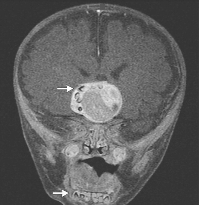 IRM du crâne du nourrisson. La flèche supérieure pointe des structures calciques dans la masse de l'hypophyse, dont le profil s'avérait étonnament similaire aux dents du bébé (flèche du bas, pointant sur la mâchoire inférieure). Source : NEJM