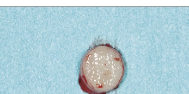 En haut, portion de cartilage prélevée par biopsie sur un patient. En bas, le cartilage obtenu à l'issue de la mise en culture du prélèvement. (Crédits: The Lancet)
