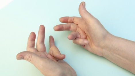 Maladie de Dupuytren : quand les doigts se rétractent (2)