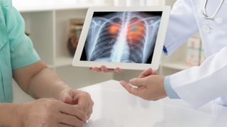 Cancer du poumon : le progrès des traitements