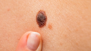 Mélanome : le plus redouté des cancers de la peau 