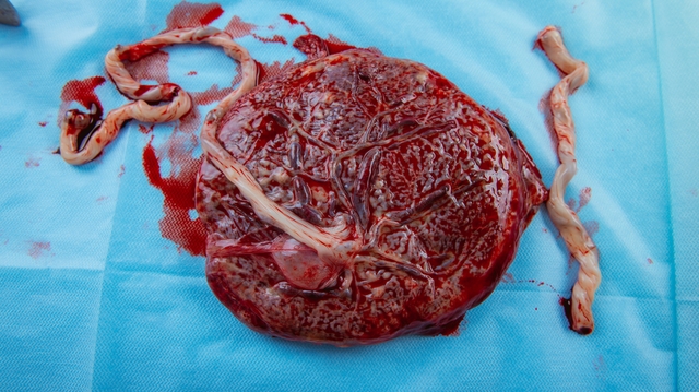 Placenta : un organe éphémère