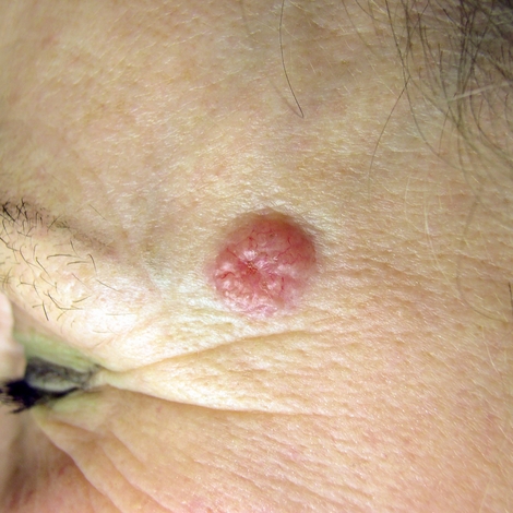Carcinome cutané : un cancer de la peau