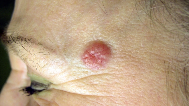 Carcinome cutané : un cancer de la peau