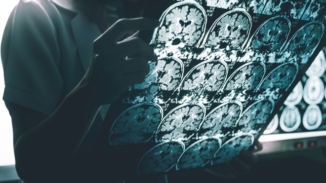 Alzheimer : dépistage, diagnostic, traitements...