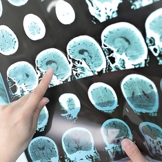 Sclérose en plaques : tout savoir sur cette maladie neurologique
