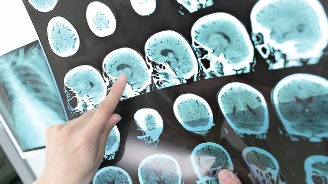 Sclérose en plaques : une maladie neurologique