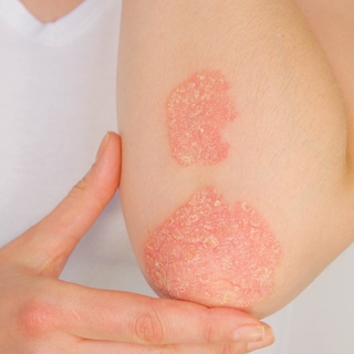 Psoriasis : une réaction auto-immune de la peau