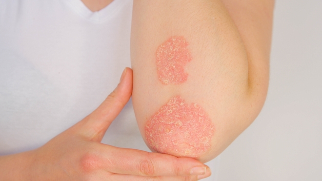 Psoriasis : une réaction auto-immune de la peau