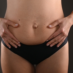 Diastasis : quand les muscles du ventre s'écartent