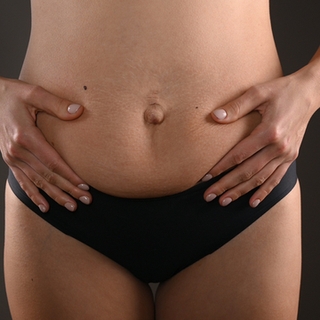 Diastasis : quand les muscles du ventre s'écartent
