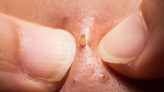 Comment éliminer ces points noirs qui nous gâchent la vie