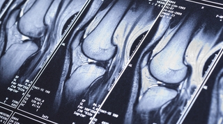 Torsion du genou : la rupture du ligament croisé