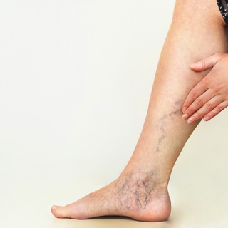 Varices : quand les veines s'emmêlent