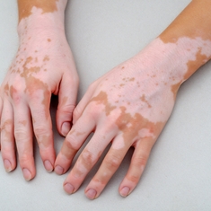 Tout savoir sur le vitiligo