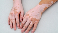 Tout savoir sur le vitiligo