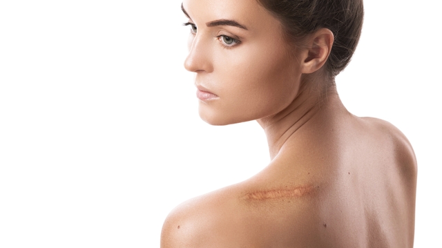 Chéloïdes : une chirurgie pour traiter ces cicatrices douloureuses